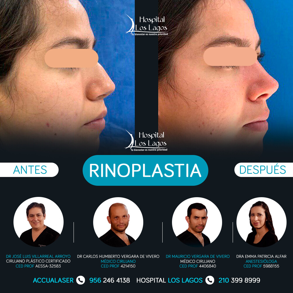 Before and After Result